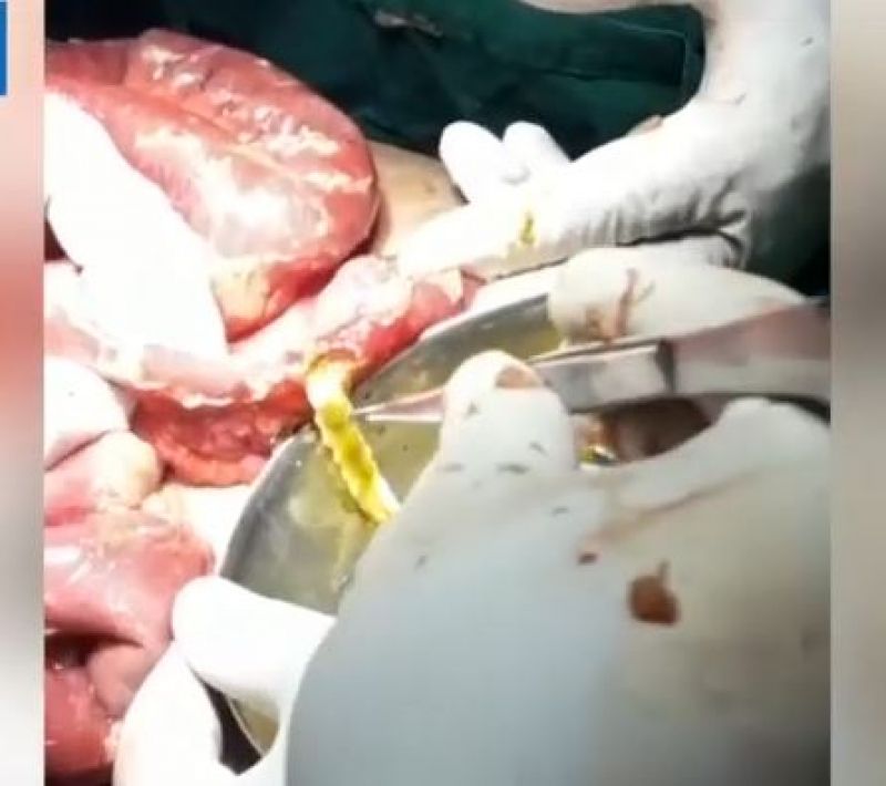 Kaithal alive insect of 6.3 feet long removed from the patients intestine