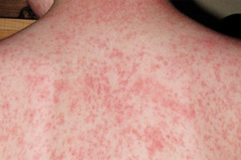 The measles outbreak is widespread in New Zealand