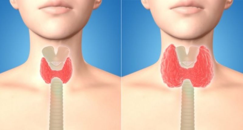 thyroid 