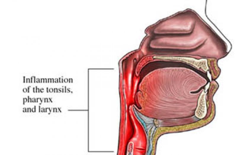 pharyngitis