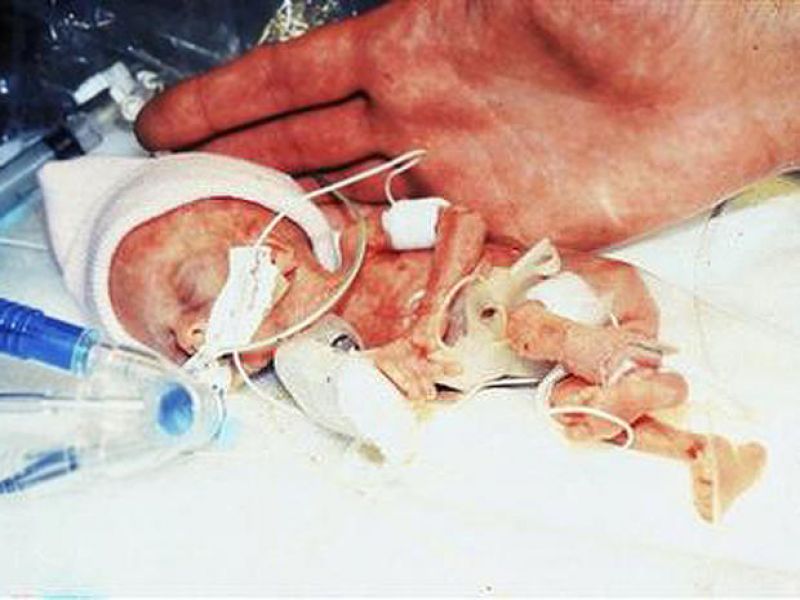 smallest surviving infant