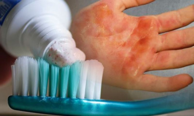 Toothpaste on burning skin