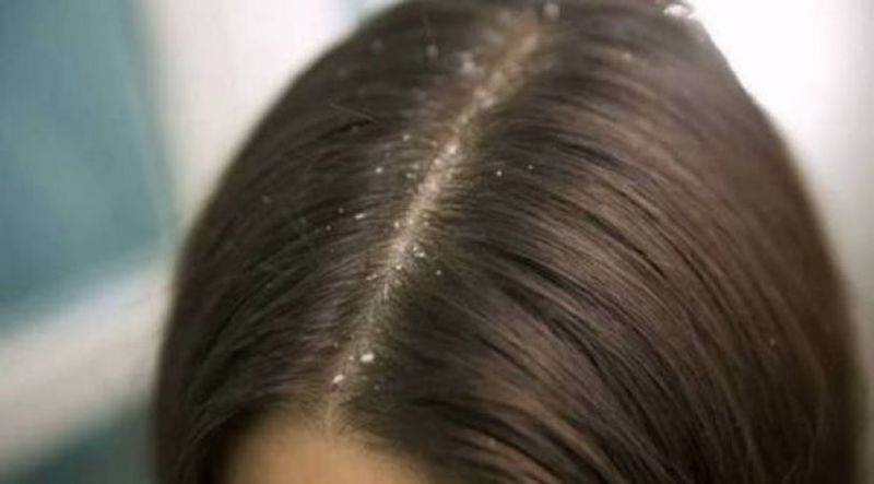 Dandruff treatment household tips