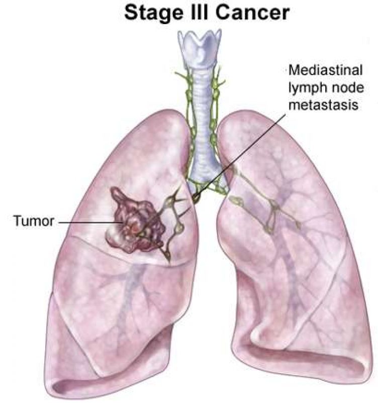 Lung Cancer