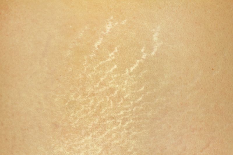 Stretch marks